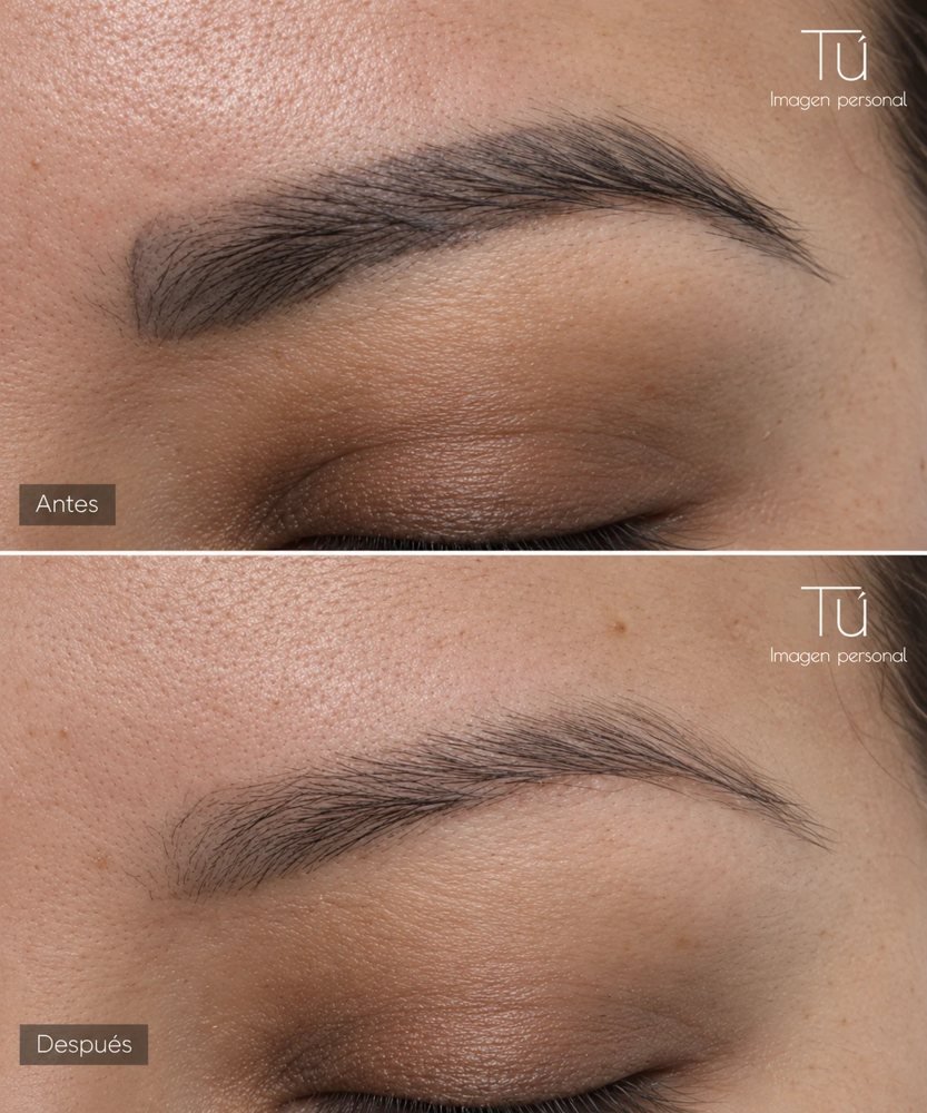 Corrección y remoción de pigmento en cejas con láser, antes y después